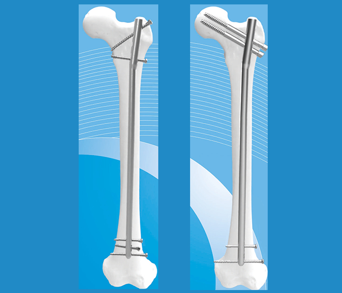 ANTEGRADE FEMORAL NAIL