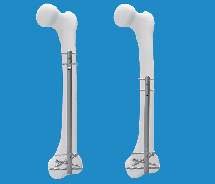 Multifunction Retrograde Femoral Nail