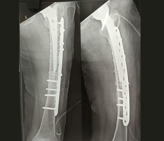 curved-broad-locking-plates-02 