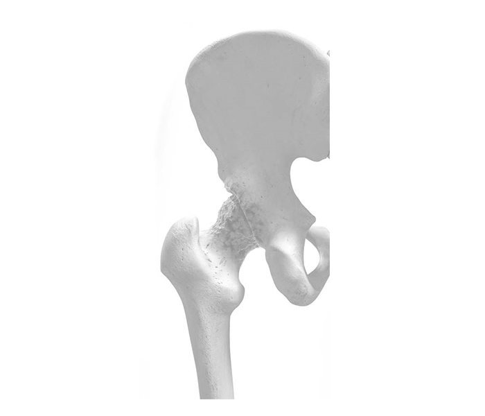 TOTAL HIP REPLACEMENT PROSTHESIS